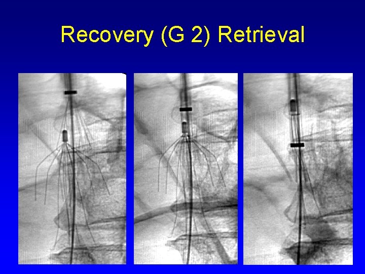 Recovery (G 2) Retrieval 