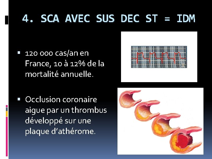 4. SCA AVEC SUS DEC ST = IDM 120 000 cas/an en France, 10