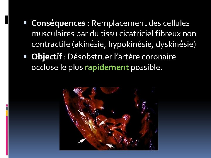  Conséquences : Remplacement des cellules musculaires par du tissu cicatriciel fibreux non contractile
