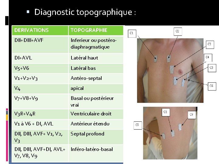 Diagnostic topographique : DERIVATIONS TOPOGRAPHIE DII+DIII+AVF Inferieur ou postérodiaphragmatique DI+AVL Latéral haut V