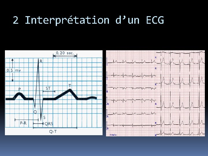 2 Interprétation d’un ECG 