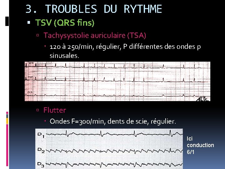 3. TROUBLES DU RYTHME TSV (QRS fins) Tachysystolie auriculaire (TSA) 120 à 250/min, régulier,