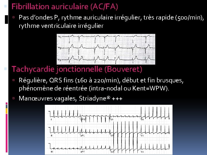  Fibrillation auriculaire (AC/FA) Pas d’ondes P, rythme auriculaire irrégulier, très rapide (500/min), rythme