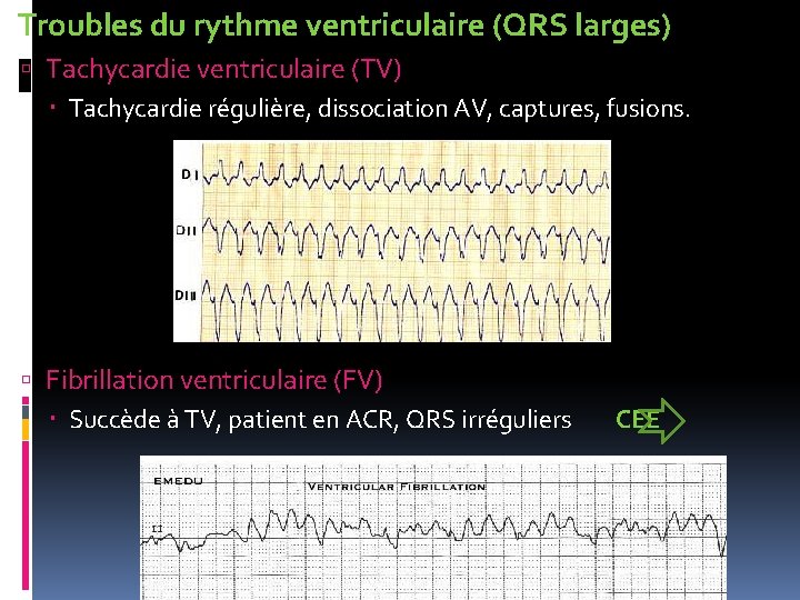  Troubles du rythme ventriculaire (QRS larges) Tachycardie ventriculaire (TV) Tachycardie régulière, dissociation AV,