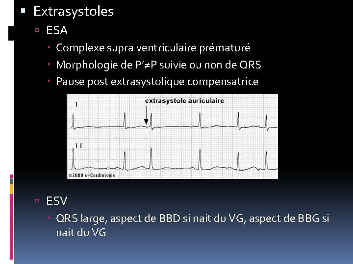 Extrasystoles ESA Complexe supra ventriculaire prématuré Morphologie de P’≠P suivie ou non de