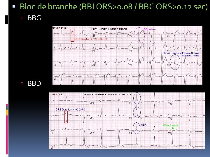  Bloc de branche (BBI QRS>0. 08 / BBC QRS>0. 12 sec) BBG BBD