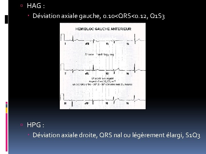  HAG : Déviation axiale gauche, 0. 10<QRS<0. 12, Q 1 S 3 HPG