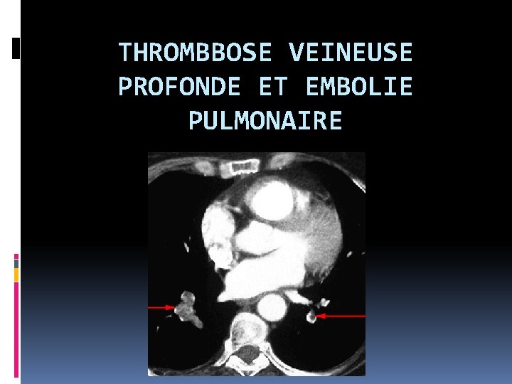 THROMBBOSE VEINEUSE PROFONDE ET EMBOLIE PULMONAIRE 