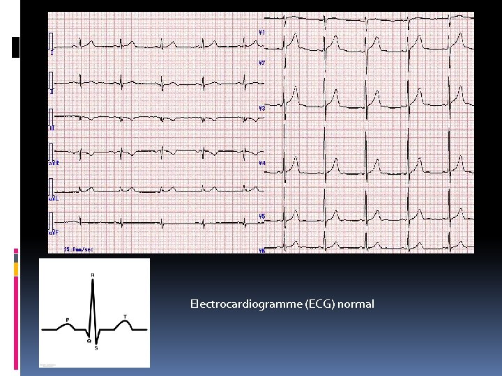 Electrocardiogramme (ECG) normal 