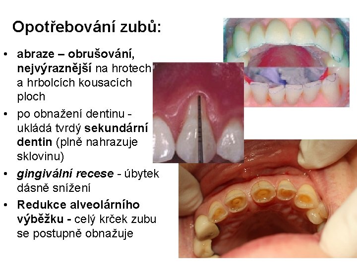 Opotřebování zubů: • abraze – obrušování, nejvýraznější na hrotech a hrbolcích kousacích ploch •