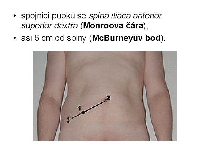  • spojnici pupku se spina iliaca anterior superior dextra (Monroova čára), • asi