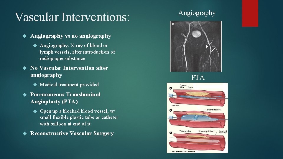 Vascular Interventions: Angiography vs no angiography Medical treatment provided Percutaneous Transluminal Angioplasty (PTA) Angiography: