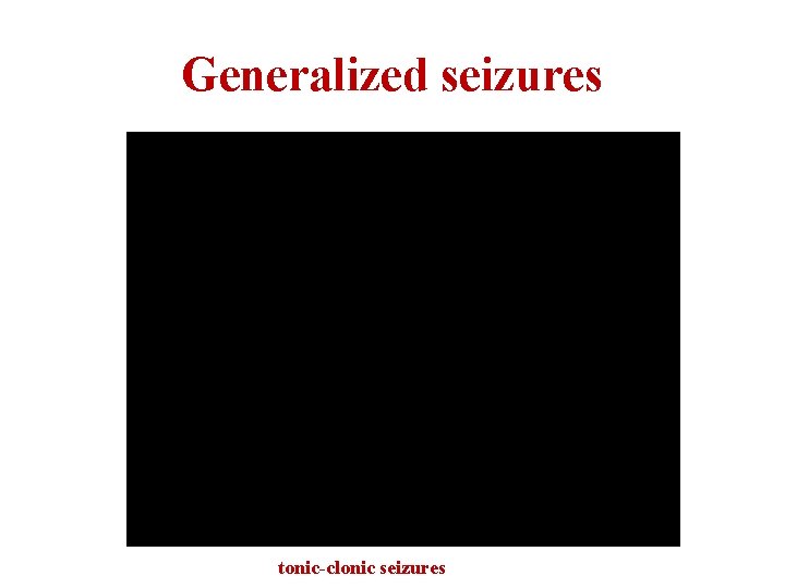 Generalized seizures tonic-clonic seizures 