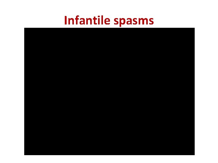 Infantile spasms 