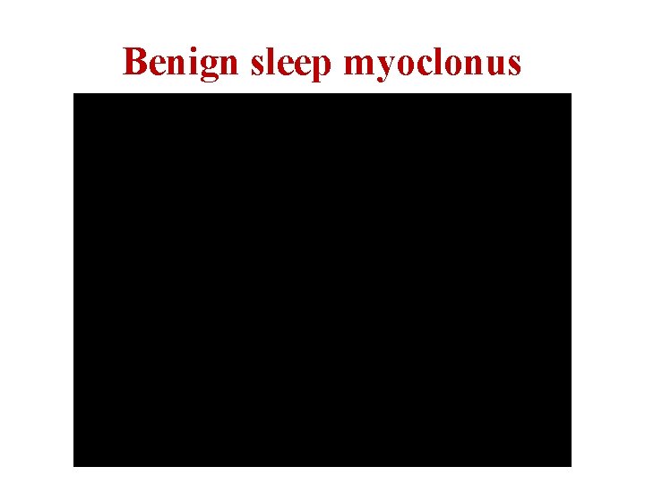 Benign sleep myoclonus 