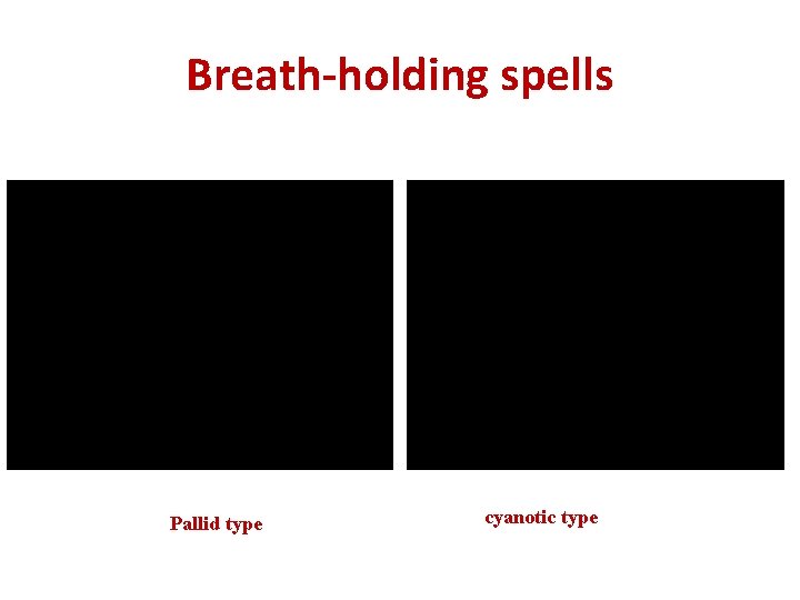 Breath-holding spells Pallid type cyanotic type 
