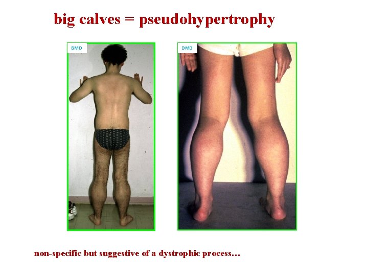 big calves = pseudohypertrophy BMD DMD non-specific but suggestive of a dystrophic process… 