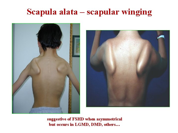 Scapula alata – scapular winging suggestive of FSHD when asymmetrical but occurs in LGMD,