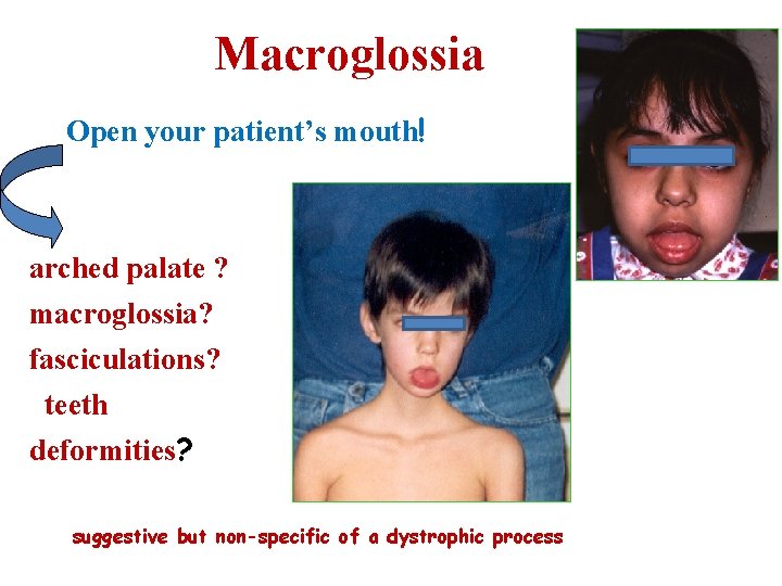 Macroglossia Open your patient’s mouth! arched palate ? macroglossia? fasciculations? teeth deformities? suggestive but