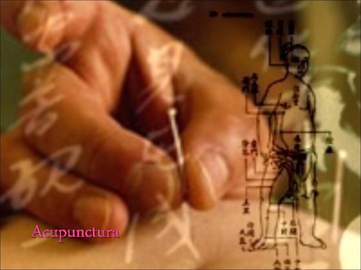 Acupunctura 