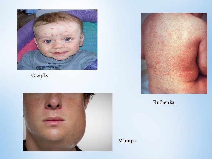 Osýpky Ružienka Mumps 