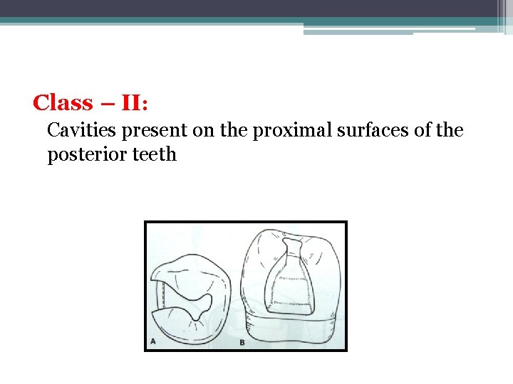 Class – II: Cavities present on the proximal surfaces of the posterior teeth 