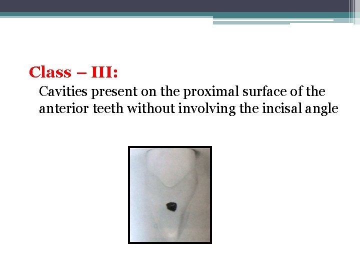 Class – III: Cavities present on the proximal surface of the anterior teeth without