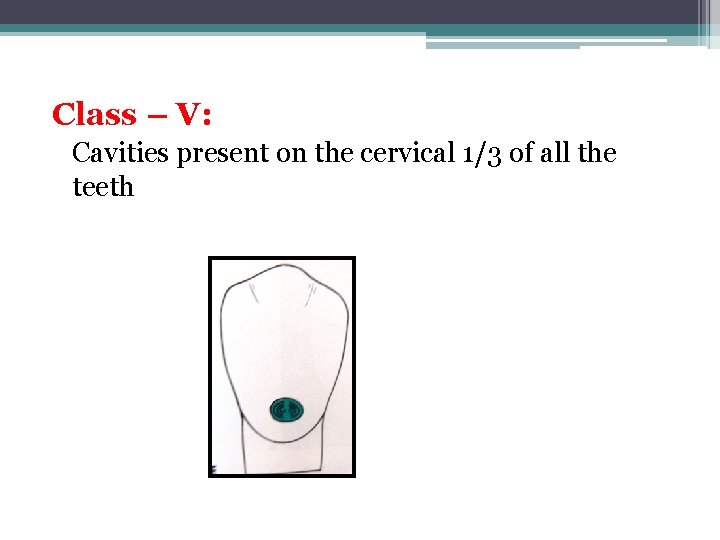 Class – V: Cavities present on the cervical 1/3 of all the teeth 