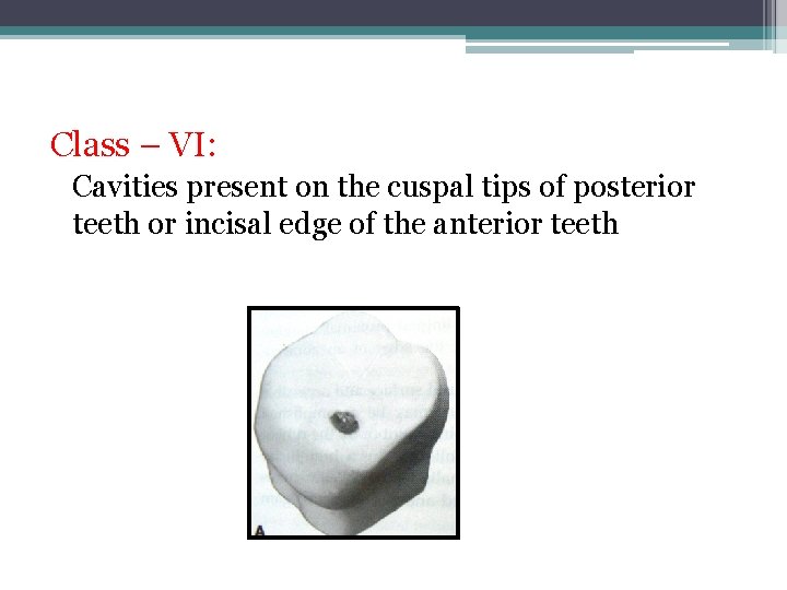 Class – VI: Cavities present on the cuspal tips of posterior teeth or incisal