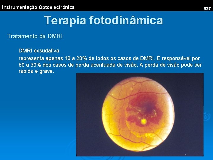 Terapie fotodinamică în oftalmologie - Tabelele pentru viziune sunt aceleași