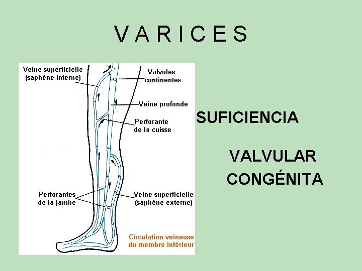 VARICES INSUFICIENCIA VALVULAR CONGÉNITA VARICES INSUFICIENCIA VALVULAR CONGÉNITA