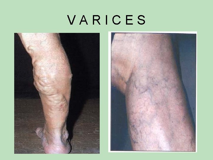 VARICES VARICES