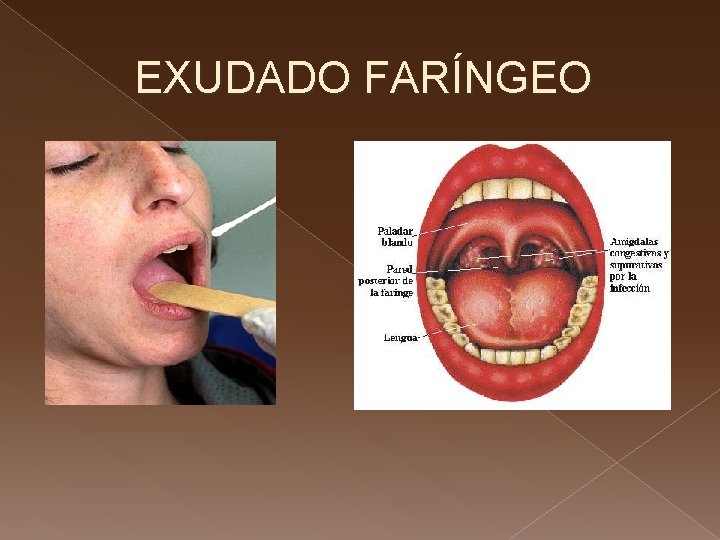 EXUDADO FARÍNGEO 