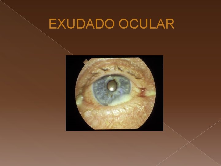 EXUDADO OCULAR 