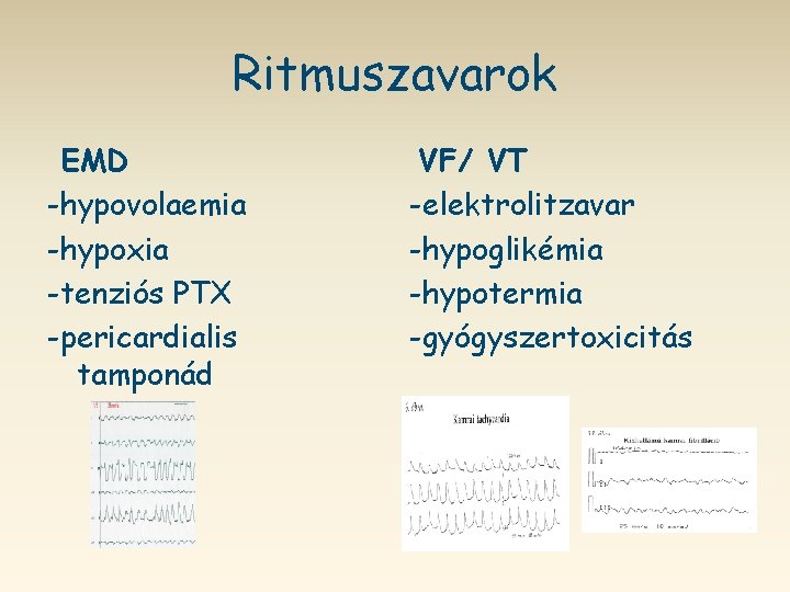 Ritmuszavarok EMD -hypovolaemia -hypoxia -tenziós PTX -pericardialis tamponád VF/ VT -elektrolitzavar -hypoglikémia -hypotermia -gyógyszertoxicitás