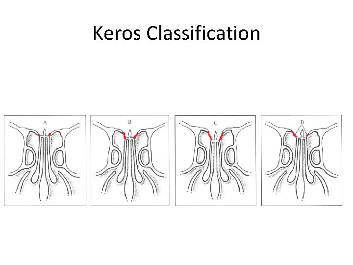 Keros Classification Keros Classification