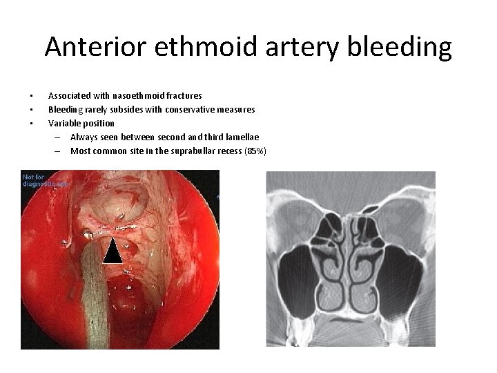 Anterior ethmoid artery bleeding • • • Associated with nasoethmoid fractures Bleeding rarely subsides Anterior ethmoid artery bleeding • • • Associated with nasoethmoid fractures Bleeding rarely subsides