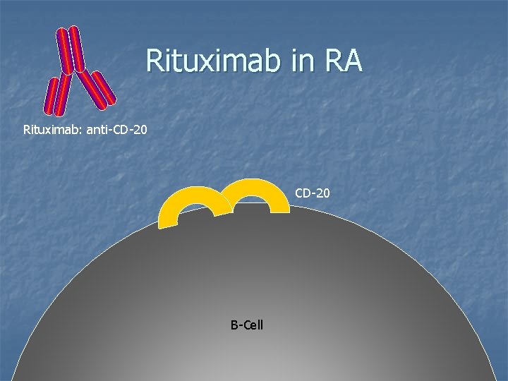Rituximab in RA Rituximab: anti-CD-20 B-Cell Rituximab in RA Rituximab: anti-CD-20 B-Cell