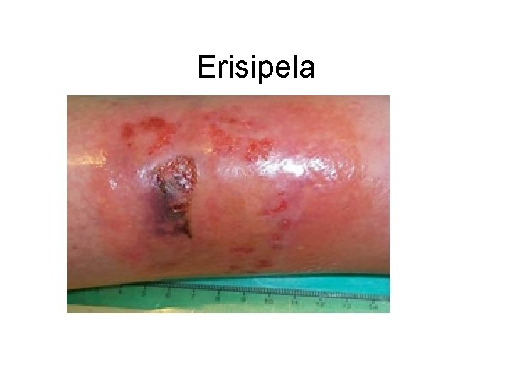 Erisipela 