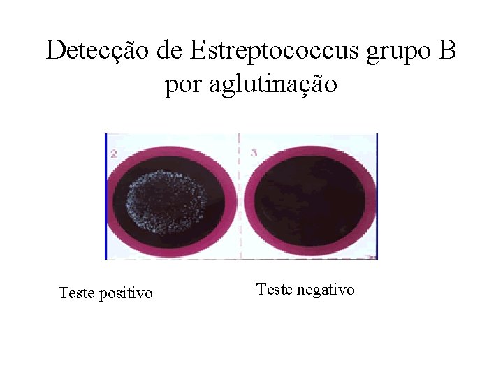 Detecção de Estreptococcus grupo B por aglutinação Teste positivo Teste negativo 