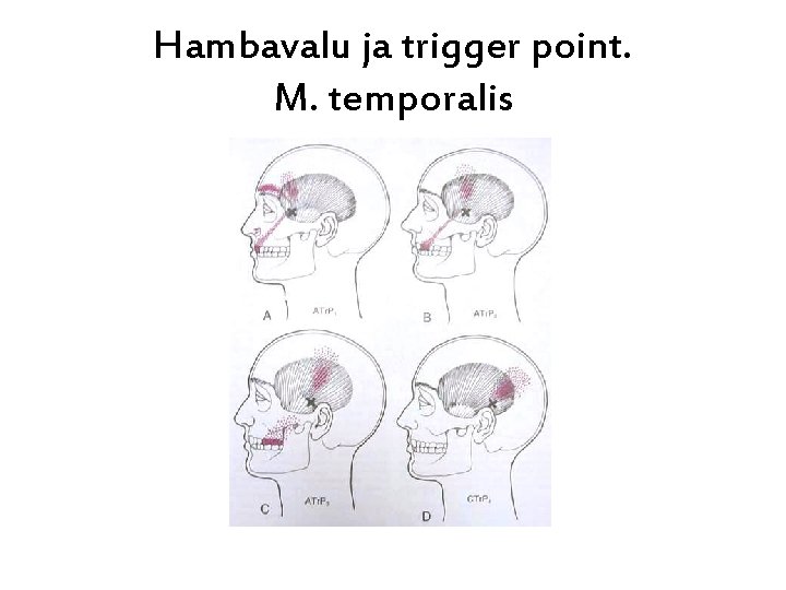 Hambavalu ja trigger point. M. temporalis 