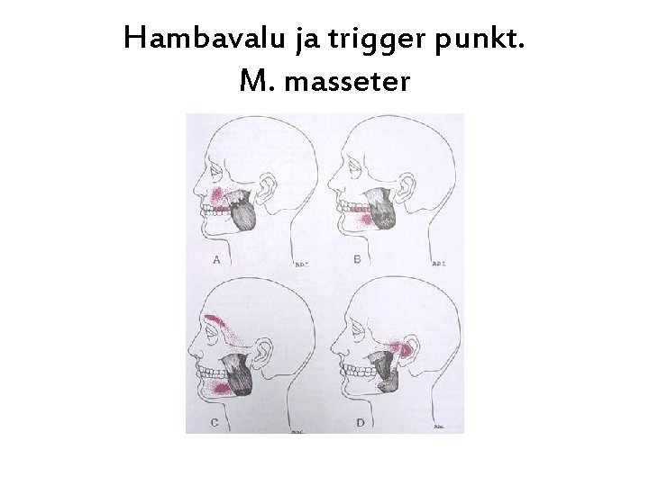 Hambavalu ja trigger punkt. M. masseter 