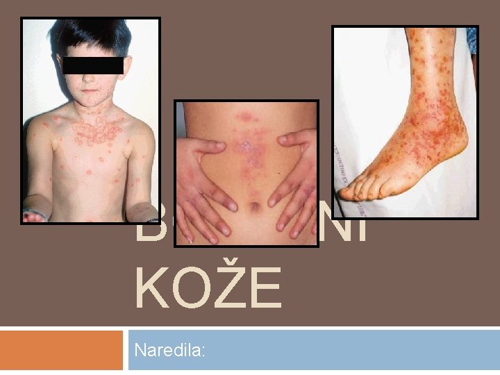 BOLEZNI KOŽE Naredila: 