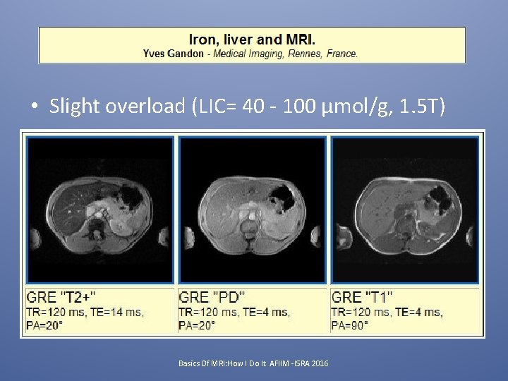  • Slight overload (LIC= 40 - 100 µmol/g, 1. 5 T) Basics Of