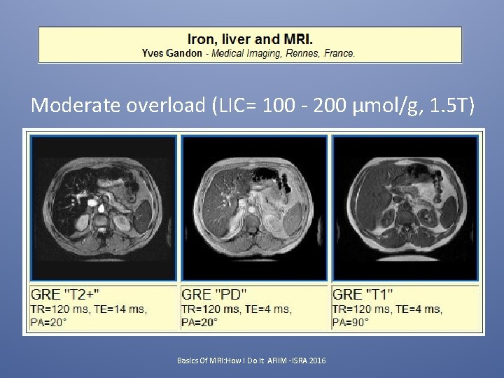 Moderate overload (LIC= 100 - 200 µmol/g, 1. 5 T) Basics Of MRI: How