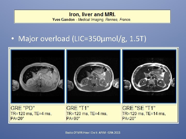  • Major overload (LIC=350µmol/g, 1. 5 T) Basics Of MRI: How I Do