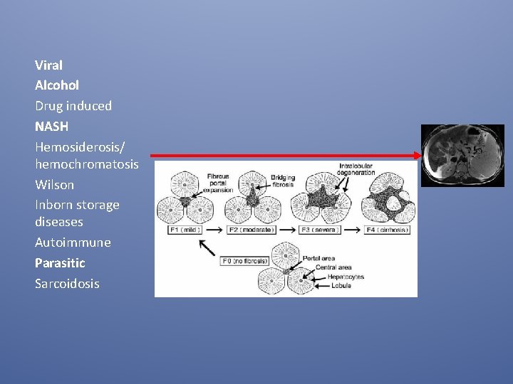 Viral Alcohol Drug induced NASH Hemosiderosis/ hemochromatosis Wilson Inborn storage diseases Autoimmune Parasitic Sarcoidosis