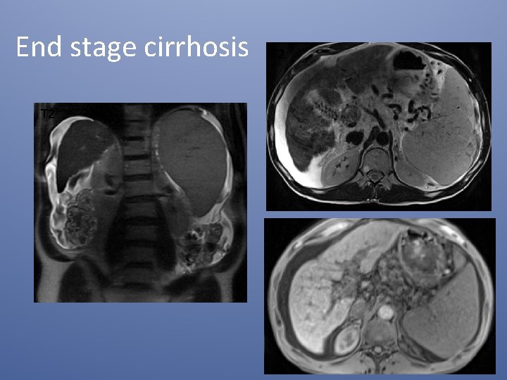 End stage cirrhosis T 2 T 1 FS 