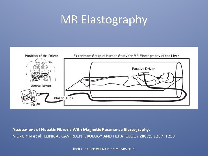 MR Elastography Assessment of Hepatic Fibrosis With Magnetic Resonance Elastography, MENG YIN et al,