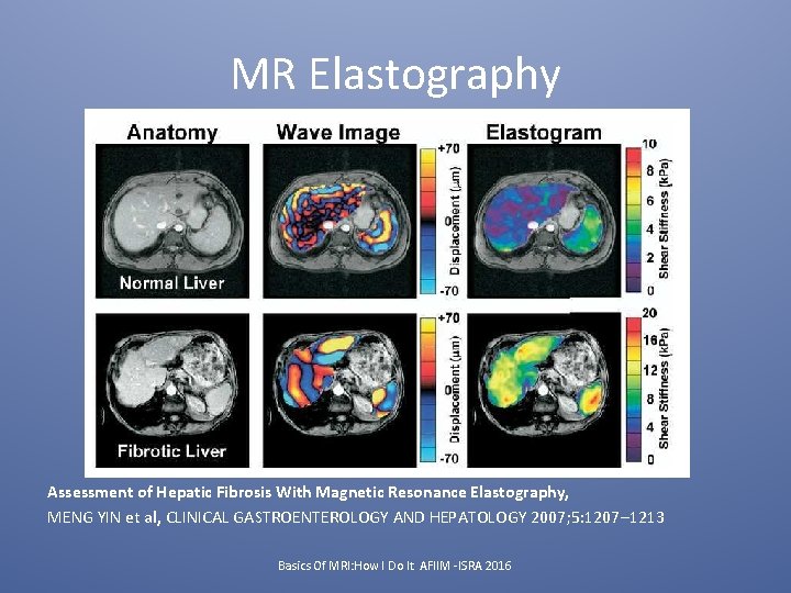 MR Elastography Assessment of Hepatic Fibrosis With Magnetic Resonance Elastography, MENG YIN et al,
